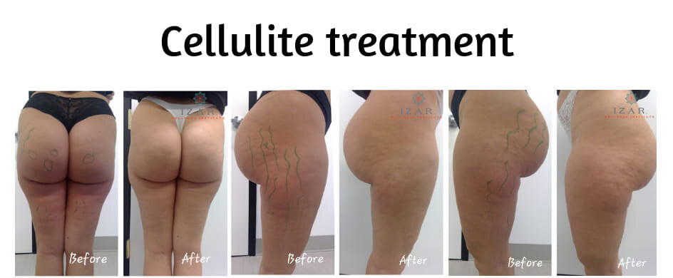 Cellulite treatment – Yaz Pro Beauty